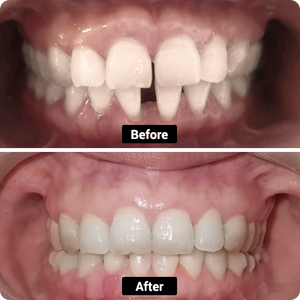 CONDIZIONE: denti geppati