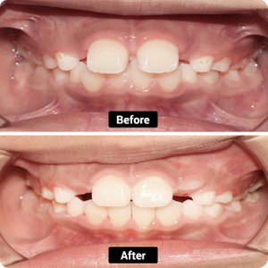 CONDIZIONE: denti overbite, overjet e distanziati