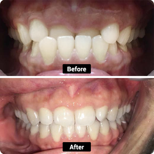 CONDIZIONE: Underbite profondo e affollato